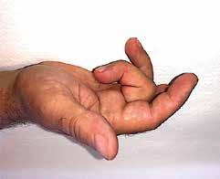 knäppningar och låsningsfenomen vid fingerflexion/ extension. Ofta uppges morgonstelhet i fingret och att fingret ibland noteras låst i flexion på morgonen.