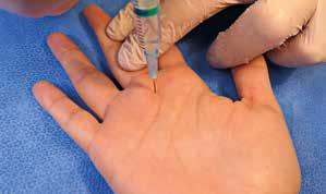 Utredning b Palpera över första annularligamentet (A1) samt flexorsenan volart distalt i handflata för aktuellt finger, samt observera eventuell ömhet eller smärta.