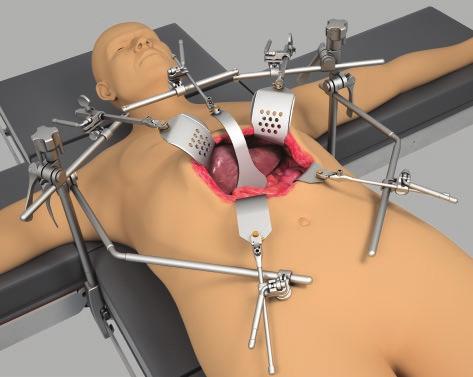 Elite Rail Clamp onto the rail over the sterile