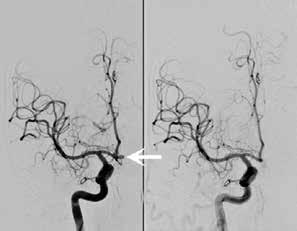 Neurokirurgisk handläggning Alla patienter med subaraknoidalblödning genomgår vid ankomst till neurokirurgisk klinik DT-angiografi av huvud för kartläggning av eventuell blödningskälla.