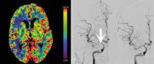 Vid negativ DT-angiografi med typisk blödningsutbredning kompletteras utredningen med kateterburen angiografi, och om även denna är negativ, vilket kan vara fallet om aneurysmet är trombotiserat,