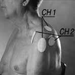 196 AXEL SUBLUXATION OCH MINSKAD RÖRLIGHET 1.