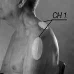 Minskad muskelfunktion i axeln efter en fraktur eller luxation m.