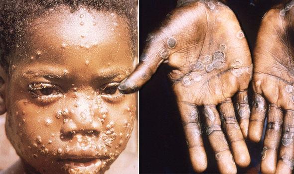 Monkeypox Släkting till smittkoppor Förekommer i tropiska regnskogsområden i centrala och västra Afrika Rapporterades först 1970 Endemisk i Demokratiska Repubiken Kongo med ca 1000 fall/år I Nigeria
