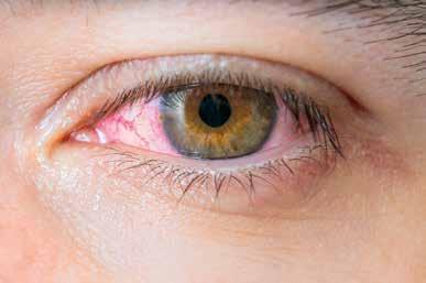 INFEKTIONER ALLERGIER /