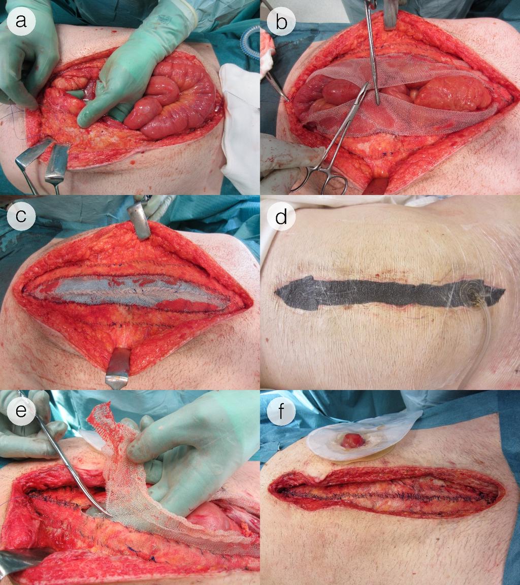 VAWCPOM Vacuumassisted Wound Closure and Permanent Onlay