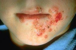 Impetigo Ytlig hudinfektion Bullös / krustös variant Krustös: Stafylokocker. Vanligast.