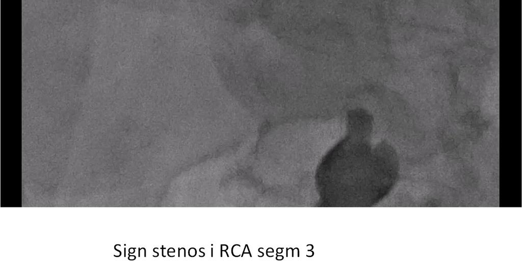 RCA segm