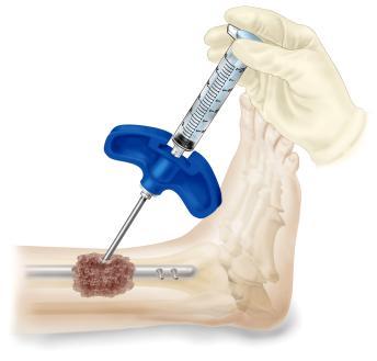 STEG 12 Efter injiceringen måste nålen lämnas ostörd i 3-5 minuter (för partiell koagulation). Dra långsamt ut nålen i små steg för att minimera backflöde.