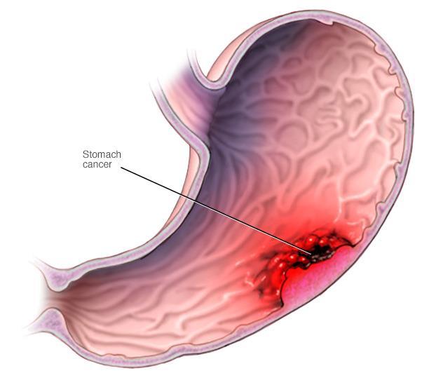 Bakgrund Magcancer Kliniska egenskaper Symptom Diagnos - biopsier Behandling Prognos Bild från: