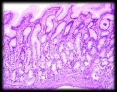 Gastritis Intestinal