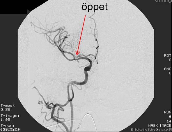 Angiografi