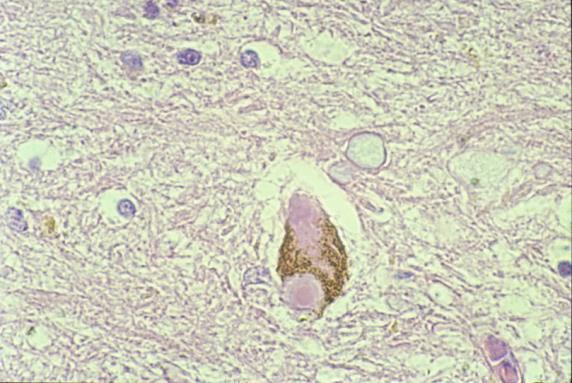 Bakomliggande patologi Patienterna med Lewy body sjukdom har Lewy bodies i hjärnan och nervsystemet (hjärnstam,