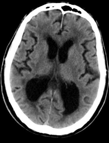 dilatation av framhornen