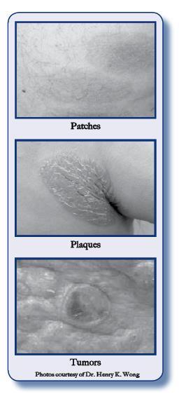 Fläckar Plack Tumörer Bilder med tillstånd av Dr. Henry K. Wong Även om MF är en indolent, kronisk sjukdom, är dess förlopp hos individuella patienter oförutsägbart.