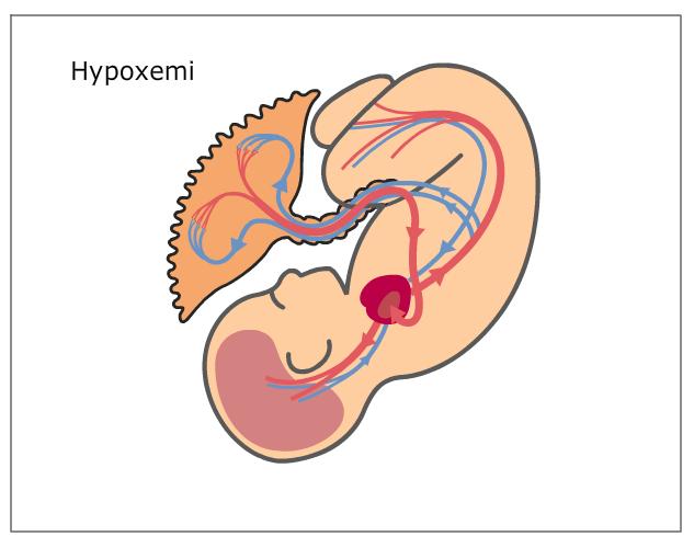 Hypoxemi Sänkt syremättnad i artärblod Hotar inte cellfunktion i vävnad Kemoreceptorer i stora blodkärl initierar