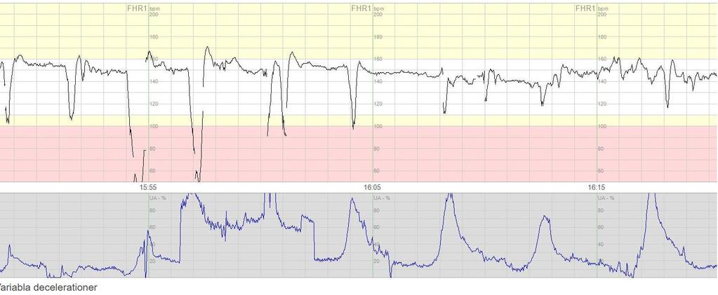 Variabla Okomplicerade = duration