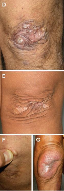 Fundamentala kliniska kännemärken: Ledhypermobilitet Hyperekstensibilitet (övertänjbarhet) av huden Bräcklighet av