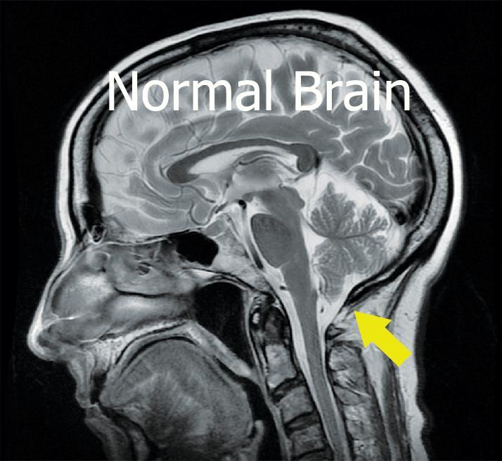 HYPERMOBILITET OCH CHIARI-MISSBILDNING (TYPE I) AVVIKANDE ANATOMI I BAKRE SKALLGROPEN en del av lillhjärnan ligger nedanför ( 5mm) foramen magnum trycket kan påverka lillhjärnan och hjärnstammen och