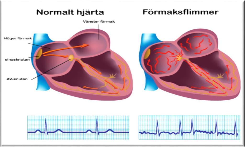 1. INTRODUKTION 1.1 Förmaksflimmer Förmaksflimmer (FF) är en av de vanligast förekommande arytmiformerna och tillhör gruppen takyarrytmier (Figur 1).