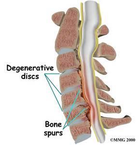Bild 15 Degenerativa ryggförändringar är vanliga Efter trauma: sämre prognos Vanligtvis symtomfria Foramenstenos: signifikant relaterat till WAD III Degenerativa förändringar är mycket vanliga.