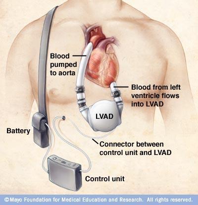 Transplantation Palliativ