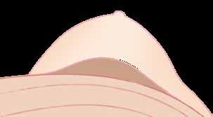 enskiktsprotes Anatomiskt utformad efter bröstkorgens naturliga form.
