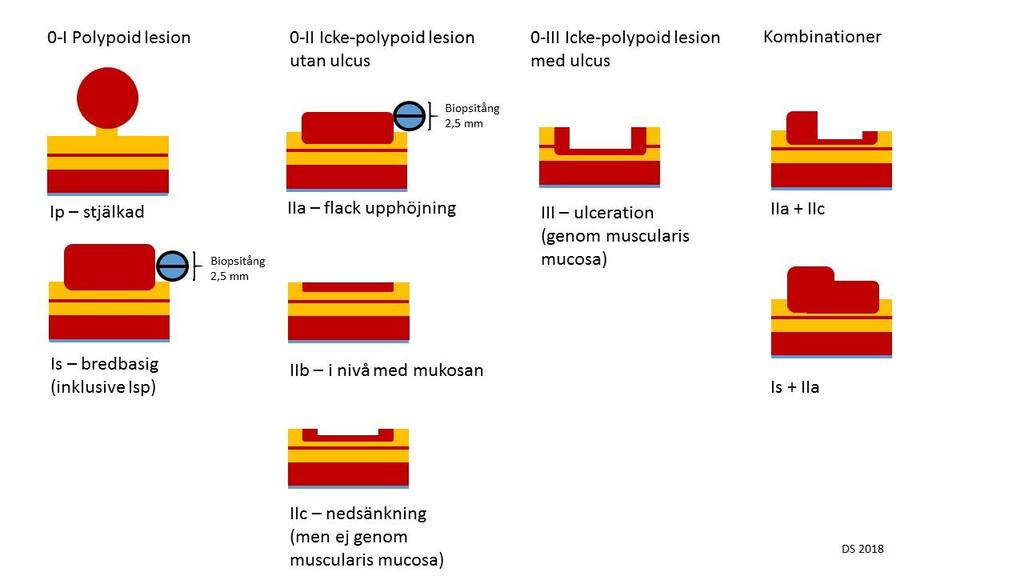 Kromoendoskopi Vid polyper med komponenter av nedsänkning (Paris IIc) finns en högre risk submukosal invasion. Dessa polyper kan också ha otydliga gränser mot frisk mukosa.