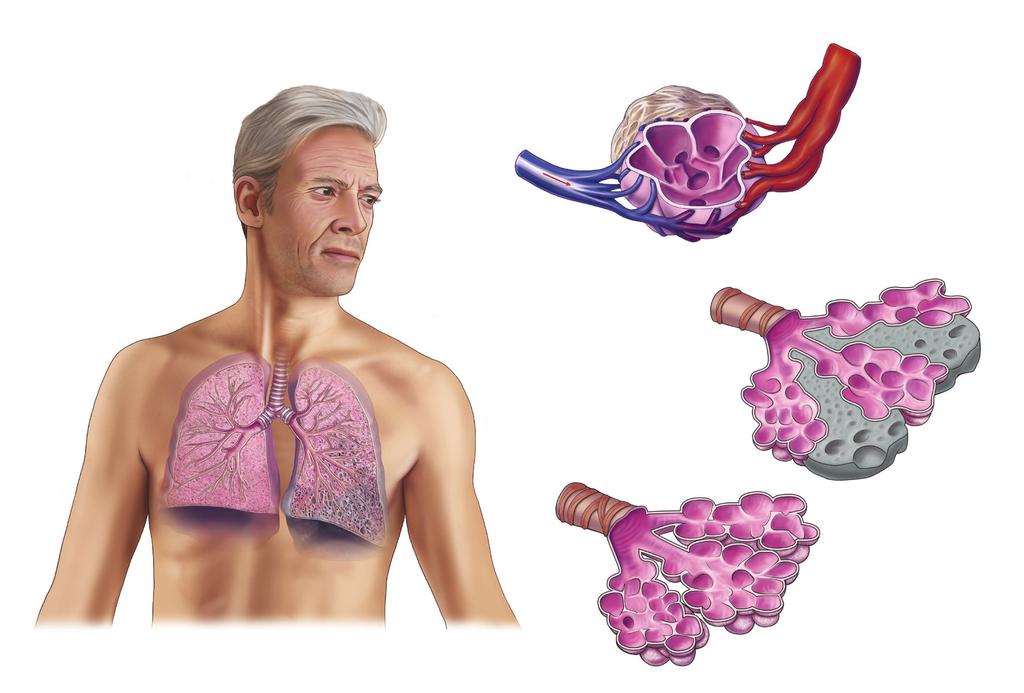 Idiopatisk lungfibros (IPF) Idiopatisk lungfibros (IPF) karaktäriseras av progressiv fibros (ärrbildning) i lungorna. Sjukdomen ger gradvis försämrad lungfunktion som leder till andfåddhet och hosta.