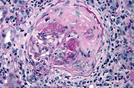 RENAL VASKULIT Mårten Segelmark Renal vaskulit Att inflammatoriska kärlsjukdomar drabbar njurarna är inte konstigt.