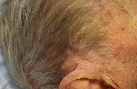 JÄTTECELLSARTERIT OCH POLMALGIA RHEUMATICA Carl Turesson Handläggning av jättecellsarterit och polymyalgia rheumatica Jättecellsarterit och polymyalgia rheumatica (PMR) är två vanliga inflammatoriska