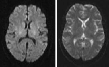 DTI (diffusion tensor imaging) vid lätt