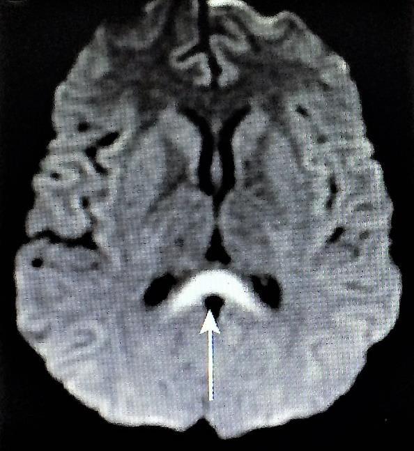 visualiseras med hjälp av CT eller MRI normal