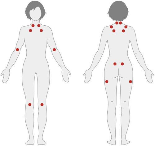 Fibromyalgi Ökad smärtkänslighet Dysfunktion i smärthämmande system Reducerade hjärnvolymer Avvikelser i transmittorsubstans Neuroinflammation Symtom Förutom muskelsmärta, ömhet Kognitiva svårigheter