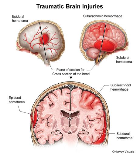 Konsekvenser av hjärnskada Funktionsstörningar: