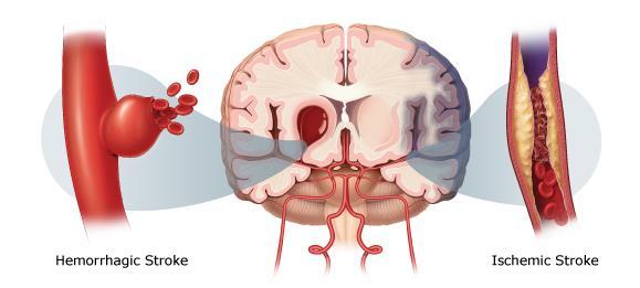 Stroke och TIA Störning i hjärnans blodflöde Ischemisk stroke tilltäppning av en av hjärnans artärer (85 % av all stroke). Hemorragisk stroke när en av hjärnans artärer brister (15 % av all stroke).