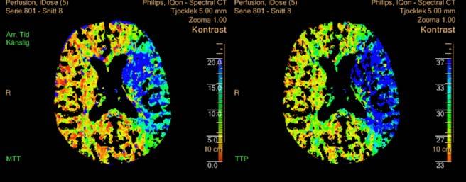 ASPECT 8 (Insula