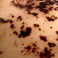 Groddbränna syns som rödbruna till gråsvarta, något insjunkna sår/fläckar på underjordiska stjälkdelar och stoloner.
