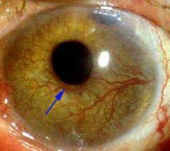 Ökad retinopati-grad ger ej ökad glaukomrisk, om