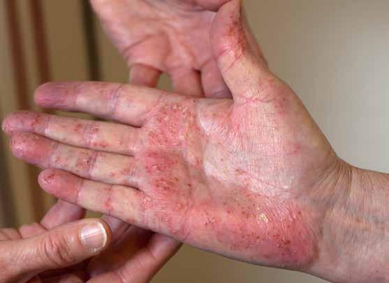 Allt fler patienter med psoriasis och psoriasisartrit får tillgång till biologiska läkemedel.