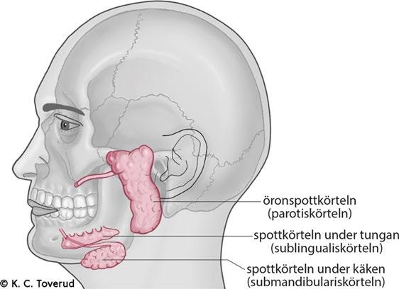 CANCER I ÖRONSPOTTKÖRTELN (PAROTIS) Varje år drabbas cirka 100 personer i Sverige av spottkörtelcancer.