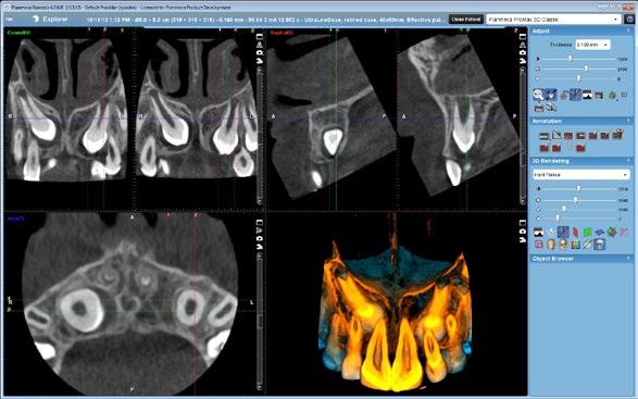 21 Från en 3D-bild kan du spara 2D-snapshots i HD-upplösning. med vad som hittills har varit akilleshälen för alla typer av dentalröntgen: artefakter och brus.