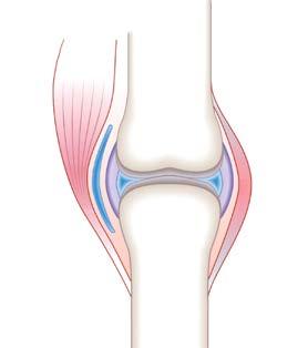 volbou u pacientů s osteoartrózou kategorie přípravků s obsahem látek označovaných SYSADOA (symptomaticky pomalu působící látky proti osteoartróze), a to především obsahujícími glukosamin sulfát nebo