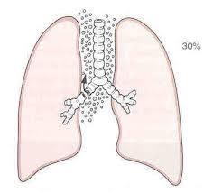 Medicinska problem vid FU Bristning i lungblåsor ger fri gas i lungvävnaden och i