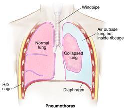 Bristning i lungkapillärer ger arteriella gasembolier (AGE) med ffa symtom från hjärnan.