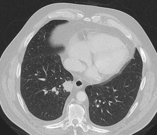 CT PET-CT