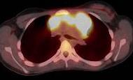 Hodgkin lymfom PET-CT