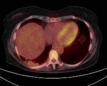 PET-CT