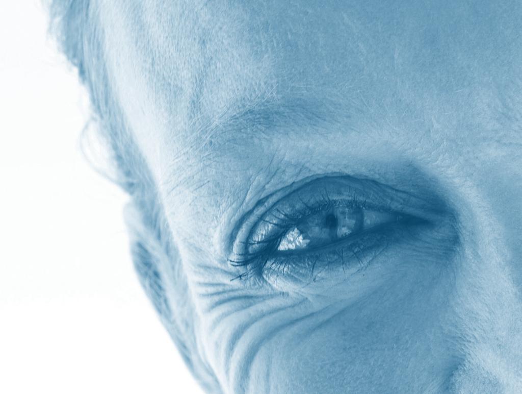 Vissa löper större risk att utveckla torra ögon. VAD ÄR DYSFUNKTION I DE MEIBOMSKA KÖRTLARNA?