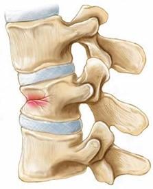 Allmän information Kotkompression (= kotfraktur) innebär att en eller flera ryggkotor har tryckts ihop. Kroppslängden påverkas då så att man blir kortare.
